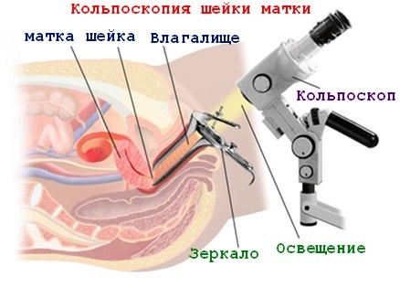 Кольпоскопия шейки матки